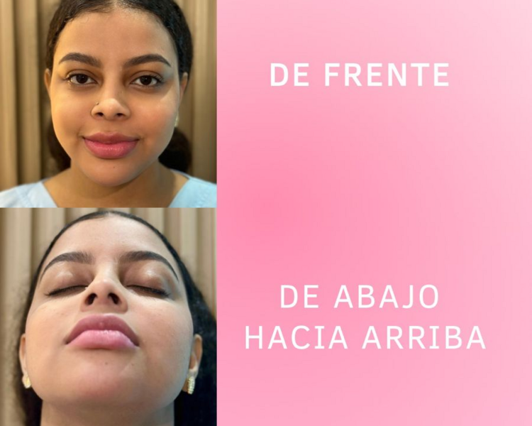 Alectomia+Rinomodelacion 