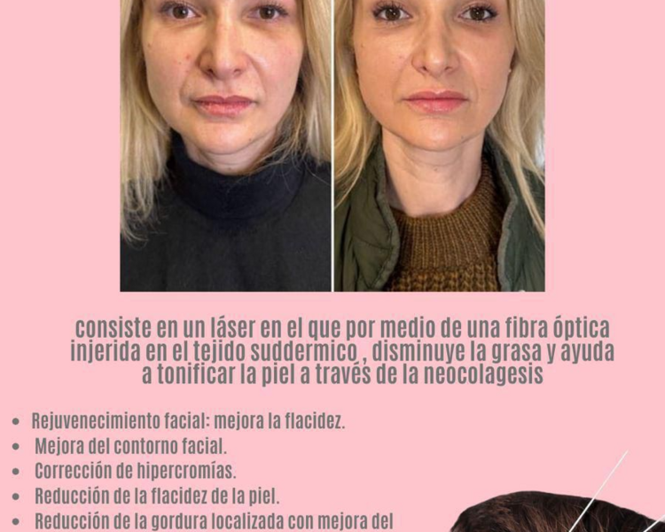 Endolifing Full Face 