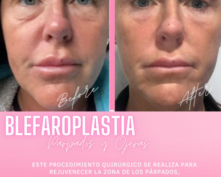 Blefaroplastia