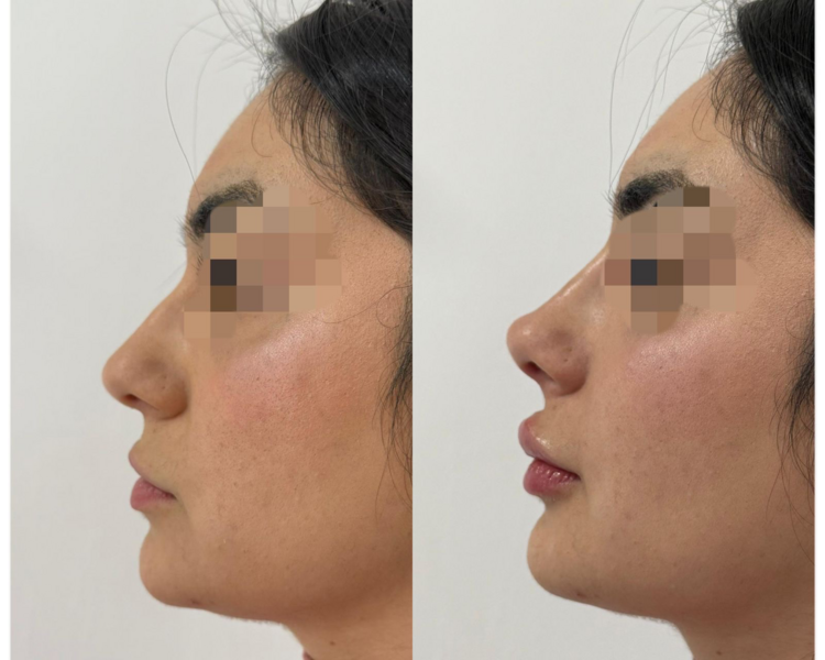 Rinolips (2 ml ) $180.000