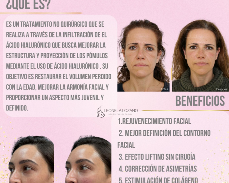 Reposicionamiento malar