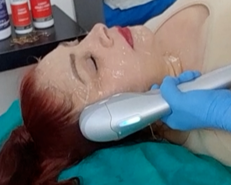 Hifu facial - rostro + papada + cuello