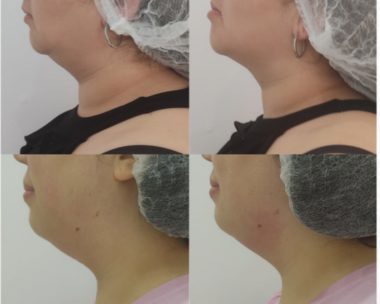 Pack papada 2 sesiones