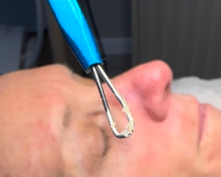 Limpieza Facial Profunda