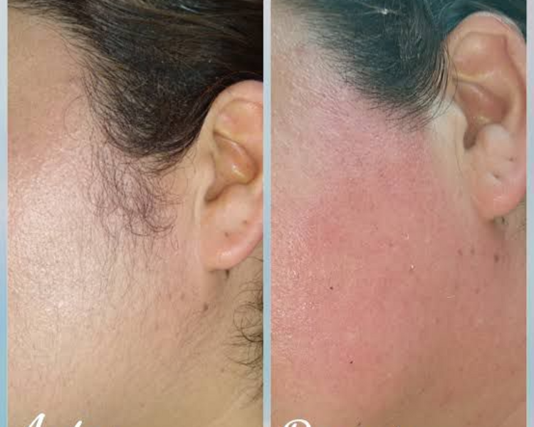 Depilaciòn ceja, bozo y patilla SL