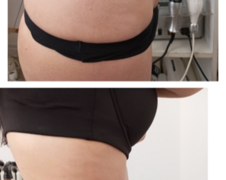 Tratamiento  Reafirmante abdomen completo 