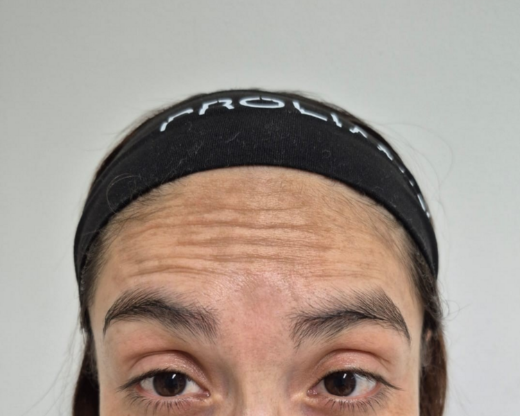 💉 Toxina Botulínica – Tercio Superior Facial (3 Zonas + Retoque)