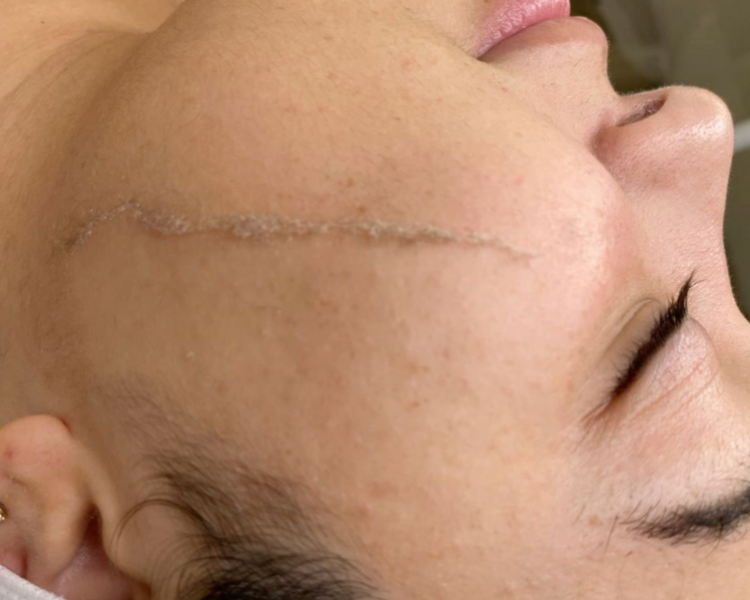 Dermaplaning (incluye limpieza facial profunda)