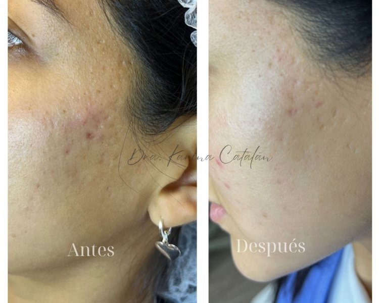 Polinucleótidos + Niacinamida (2 sesiones)