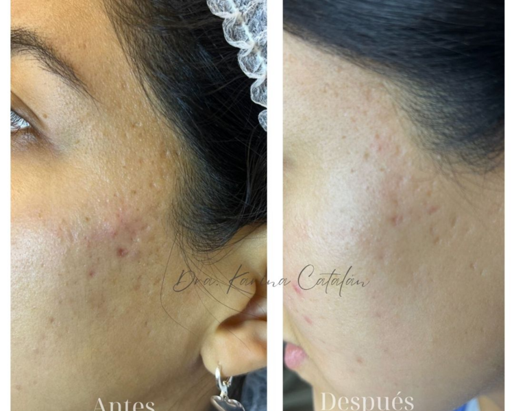 Polinucleótidos + Niacinamida