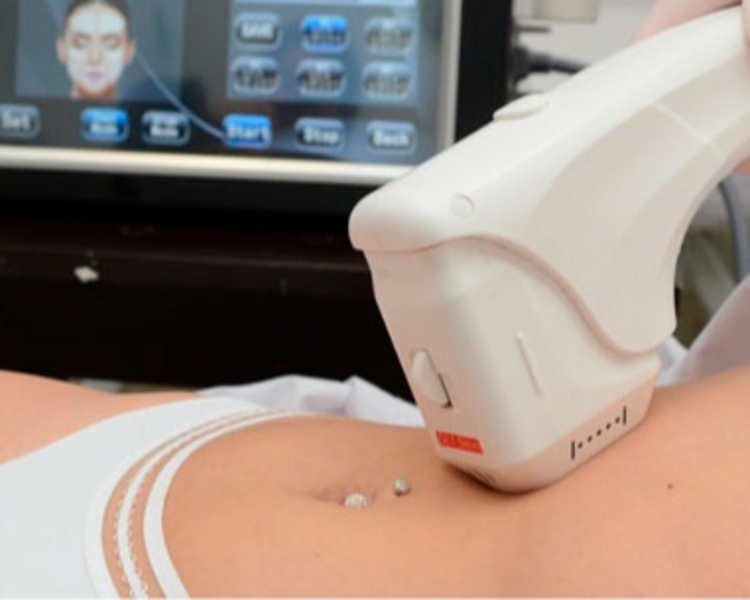 3 sesiones HIFU Abdomen 