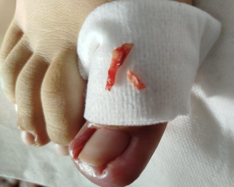 Tratamiento de uñas encarnadas (segun valoración)