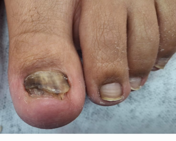 Tratamiento de Hongos en la Uñas (segun valoración)