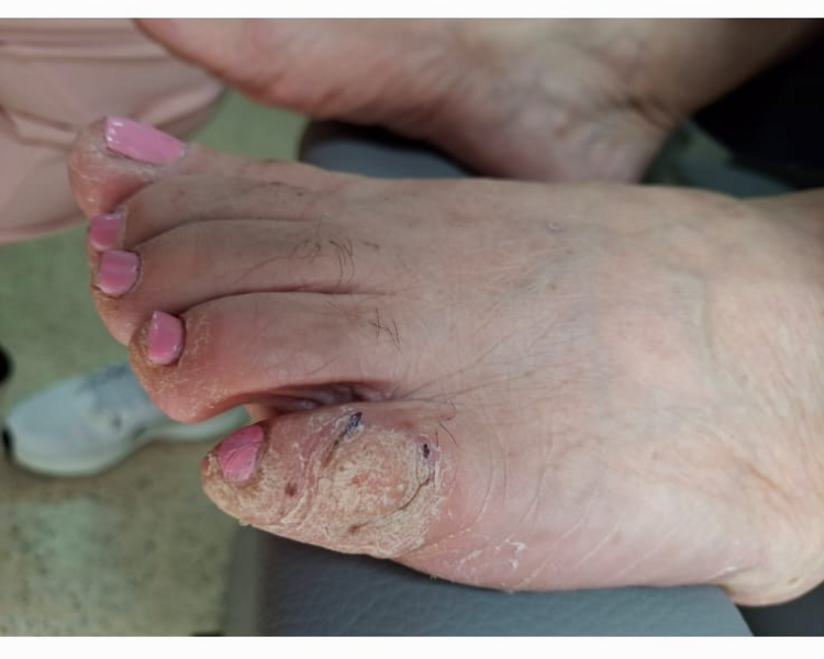 Eliminación de callos y durezas (Segun Valoración)