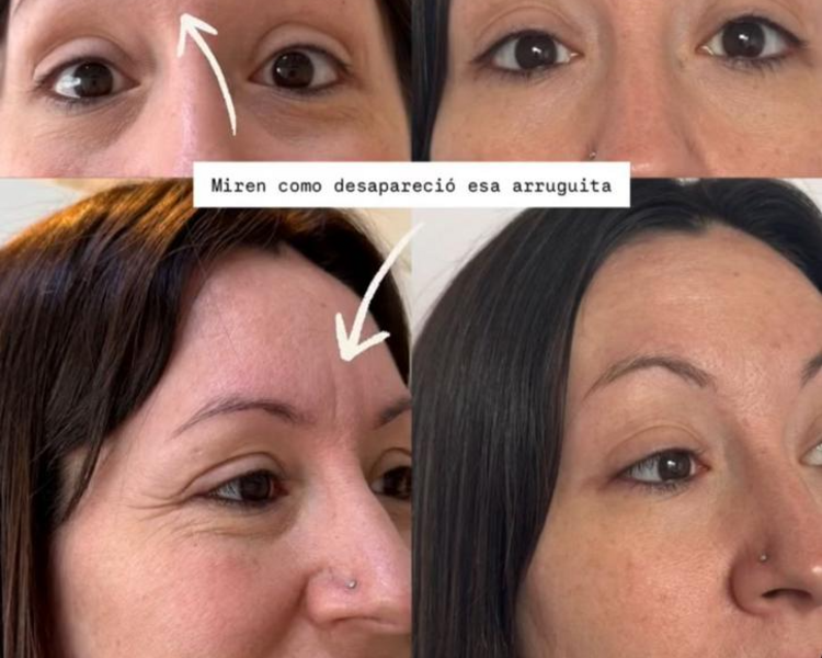 Toxina Botulinica (botox) tercio superior