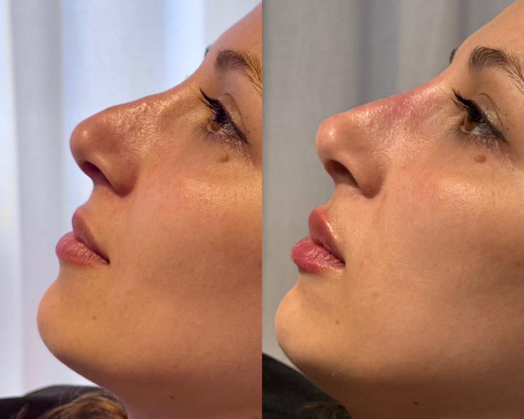 Rinomodelación con acido hialuronico