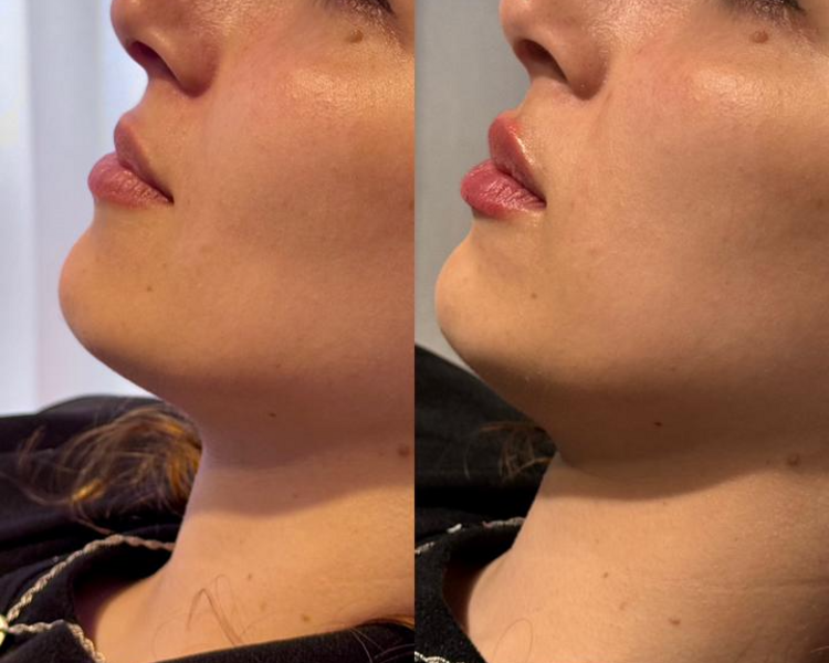 Diseño de Labios con acido hialuronico