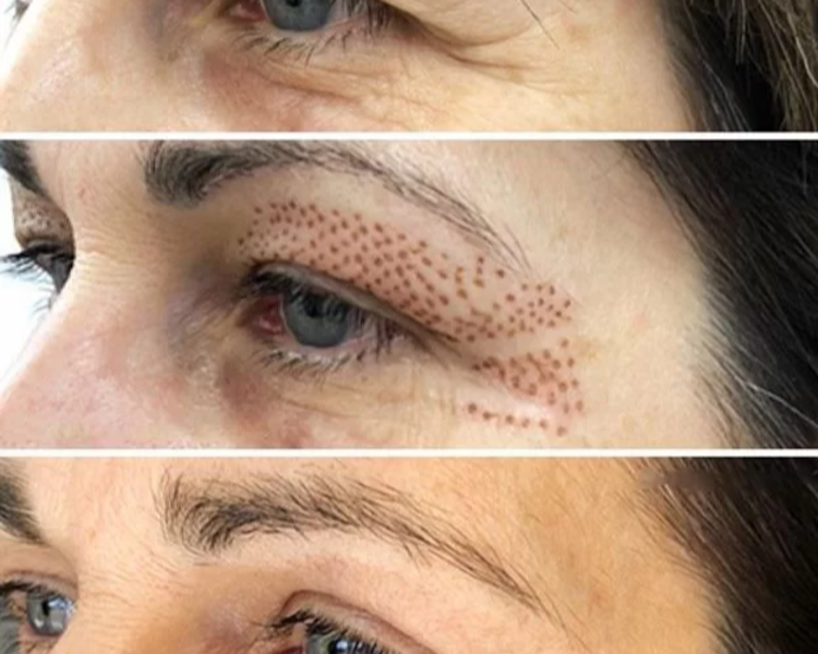 Blefaroplastia con Plasma Pen