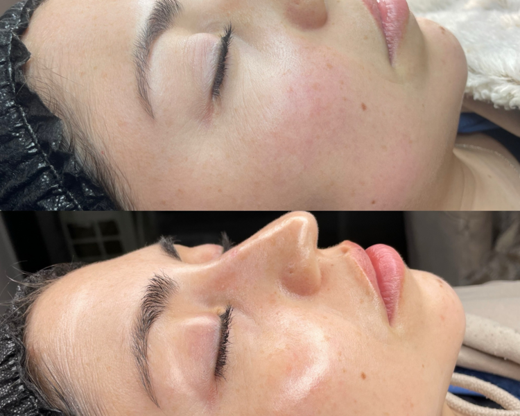  Dermapeel Casmara 