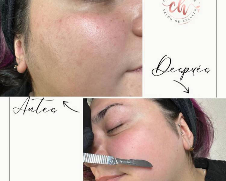 Dermaplaning o Mesoexfoliacion