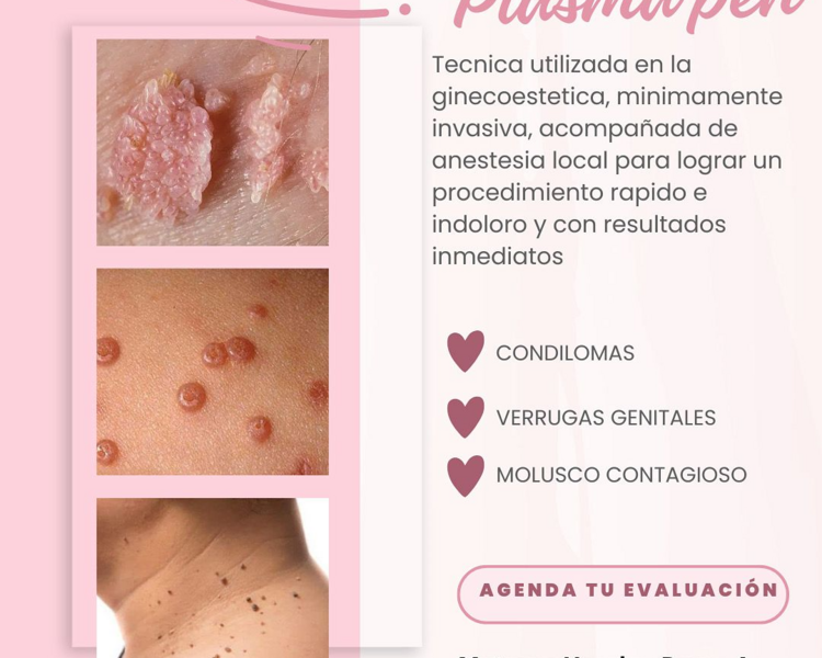 Plasmapen (precio desde 45.000)