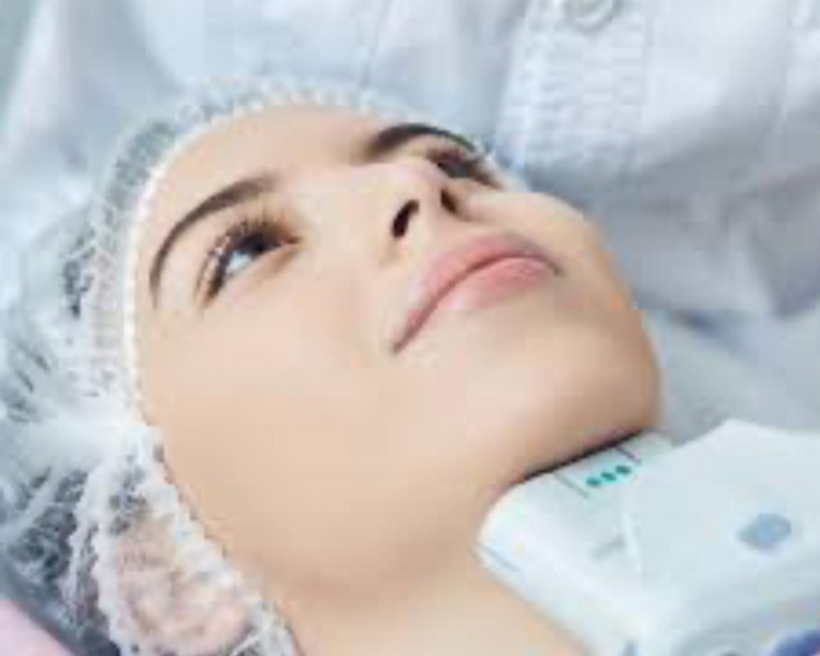 HIFU Rostro completo, papada y cuello ( 1 sesión )