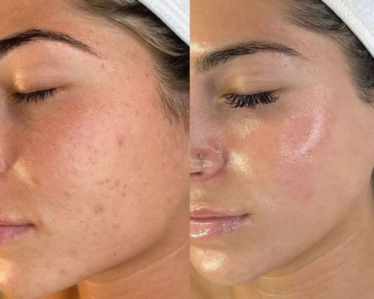 LIMPIEZA FACIAL PROFUNDA CON EXTRACCIONES