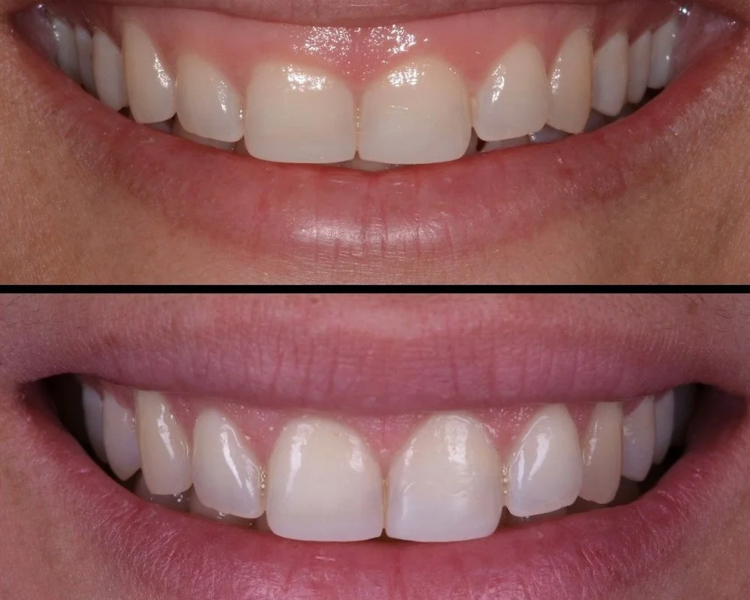 😃 Sonrrisa gingival