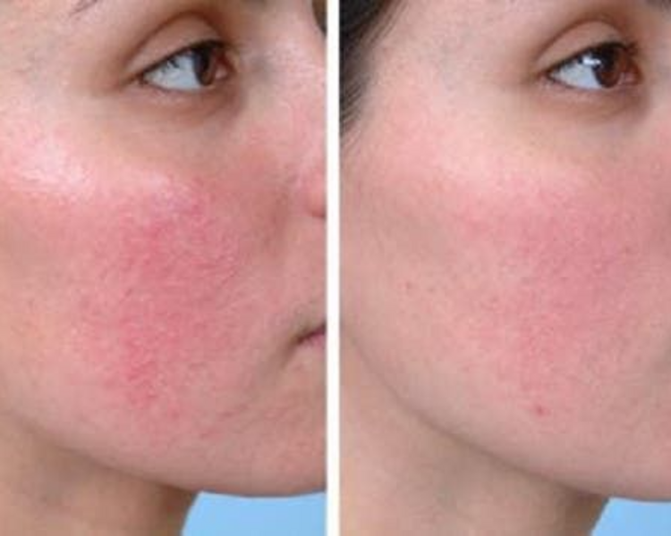 Tratamiento rosácea