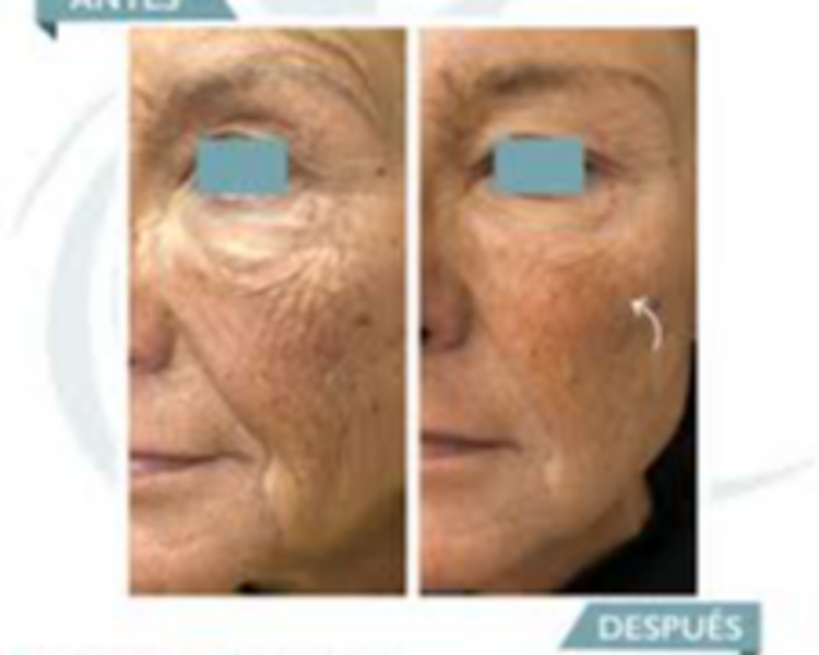 Radiesse ®: (Bioestimulador y relleno con hidroxiapatita de calcio)