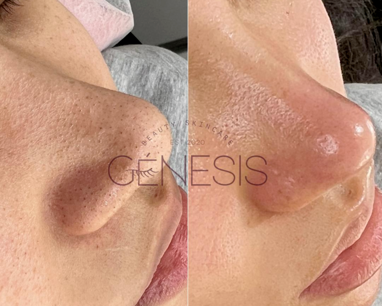 Limpieza facial profunda