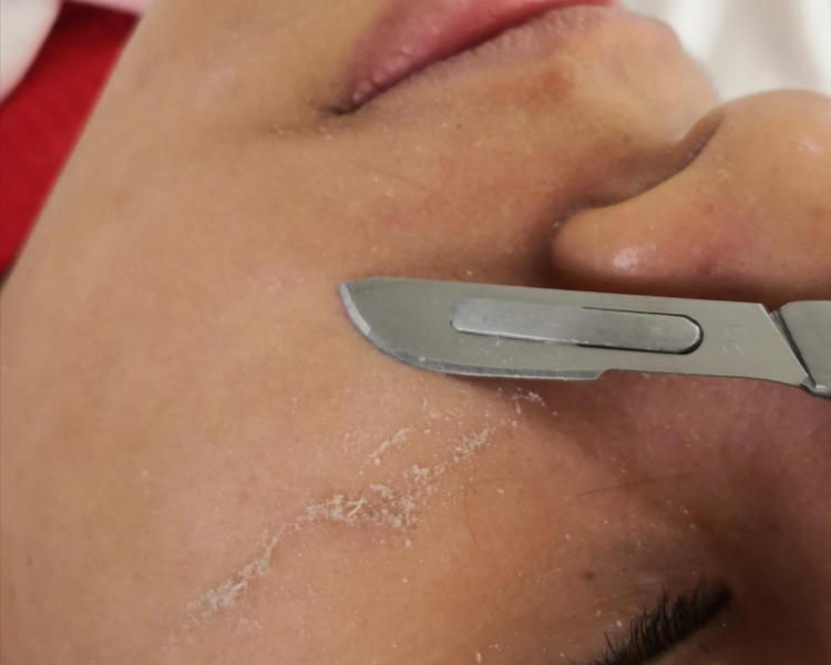 Limpieza profunda + Dermaplaning + Peeling químico
