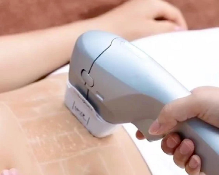 HIFU Abdomen ( 1 sesión )