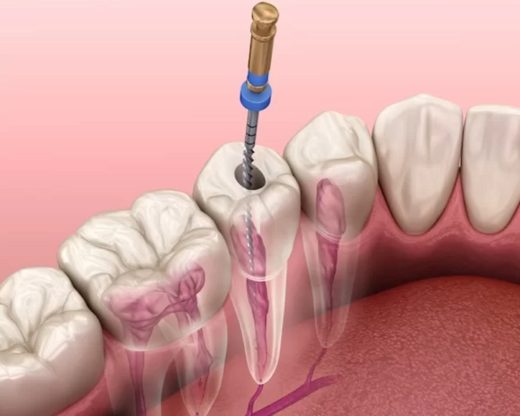 Tratamiento de conducto (anteriores)
