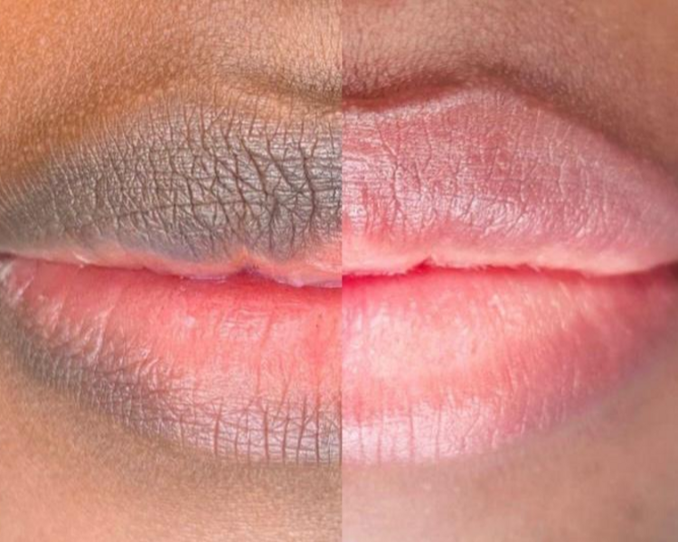 Neutralización de Labios con Micropigmentación