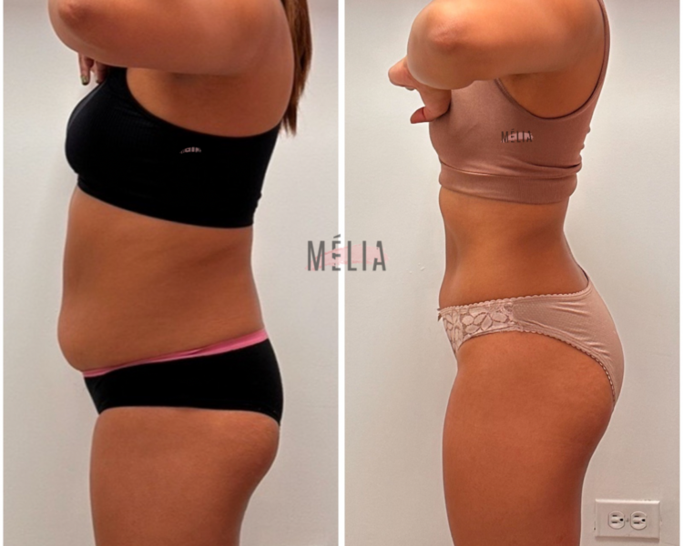 Lipo Cintura Membresia 