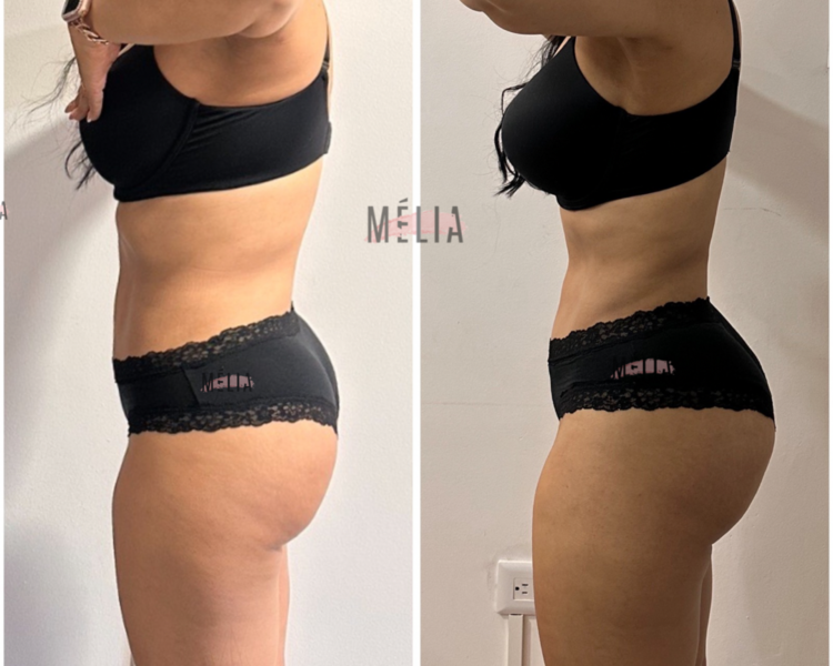 Membresia Cerrado de cintura con transferencia a glúteos 