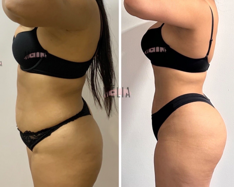 Lipo sin Cirugia Sesión