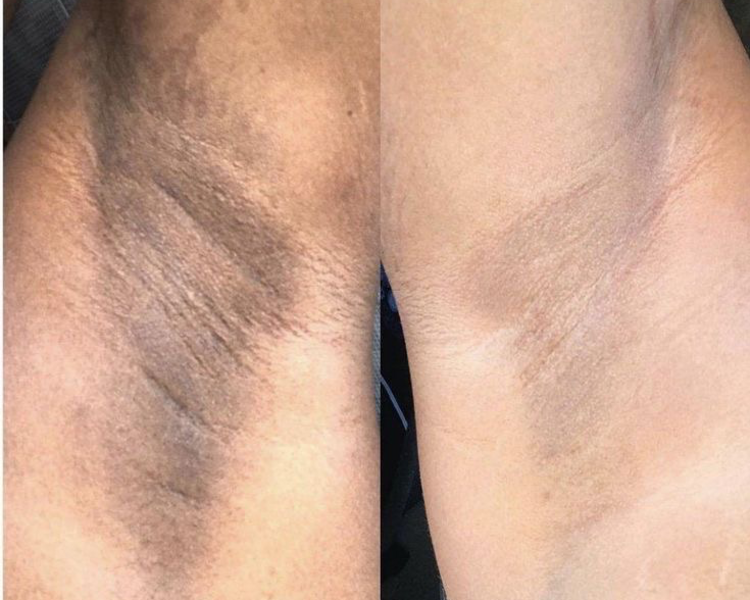 Aclarado axilas con laser 