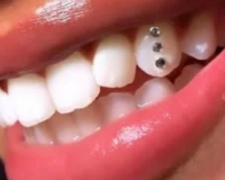 Joya dental 2 cristales 