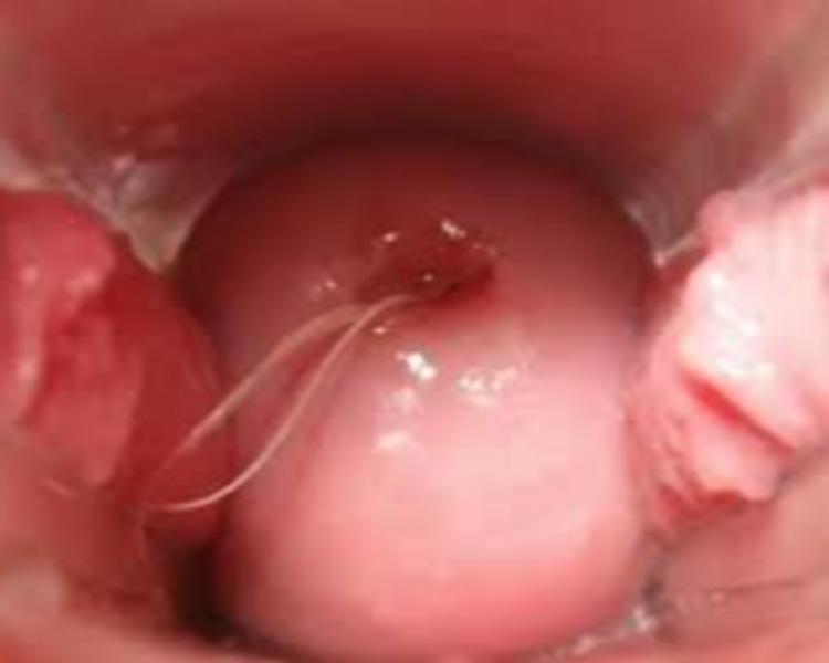 Extracción de Dispositivo Intrauterino (T de cobre u Hormonal) Incluye consulta con Matrona 