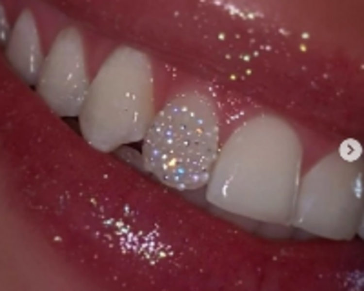 Efecto sugar 1 diente 