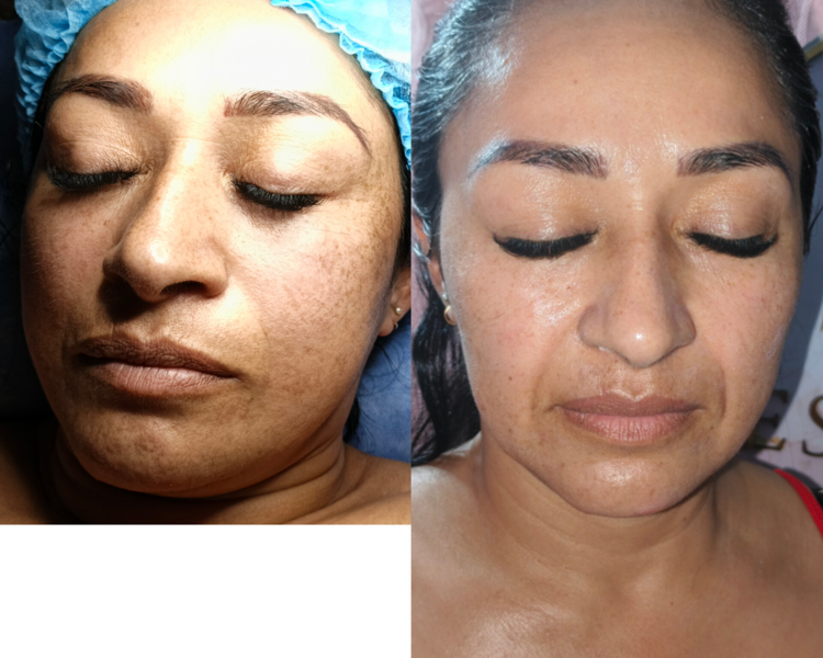 Limpieza facial profunda 