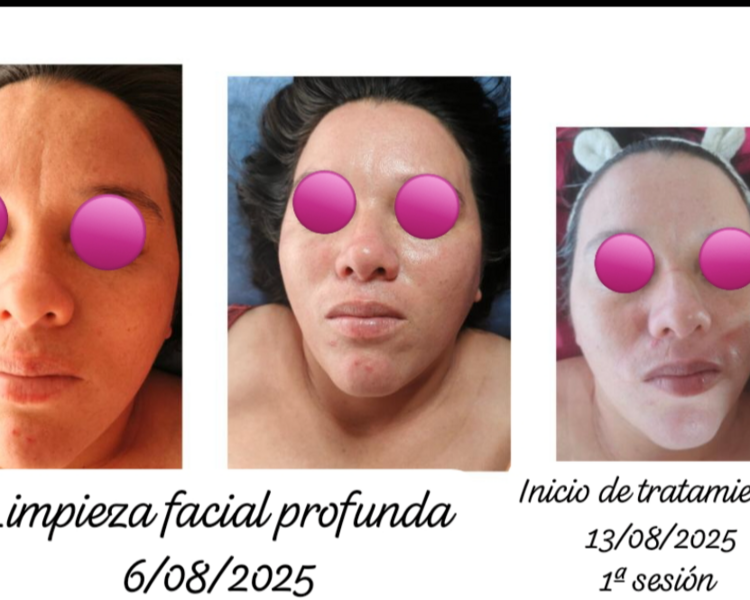 Tratamiento facial 