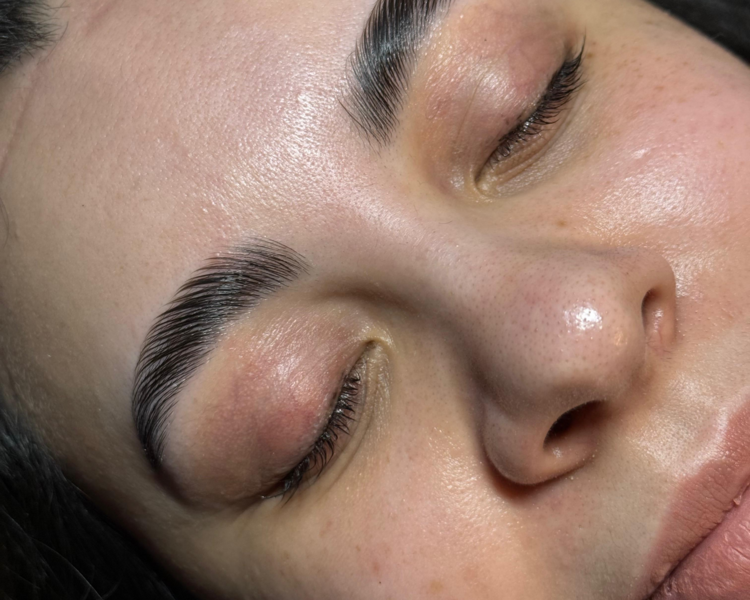 Brow Lifting
