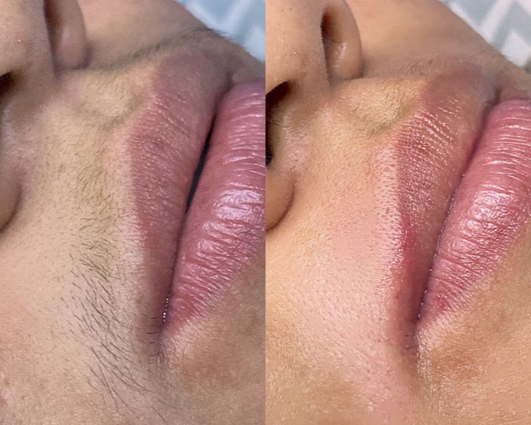 Depilacion de Bozo con cera 