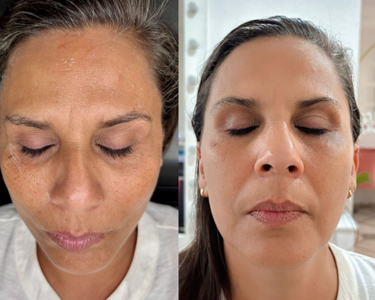Facial Antienvejecimiento con limpieza parcial 