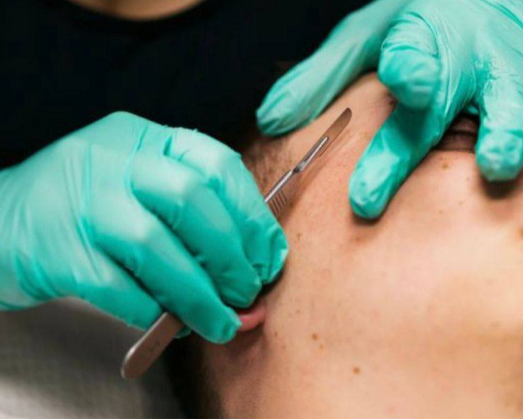 SESIÓN NUEVA PIEL ( DERMAPLANING )