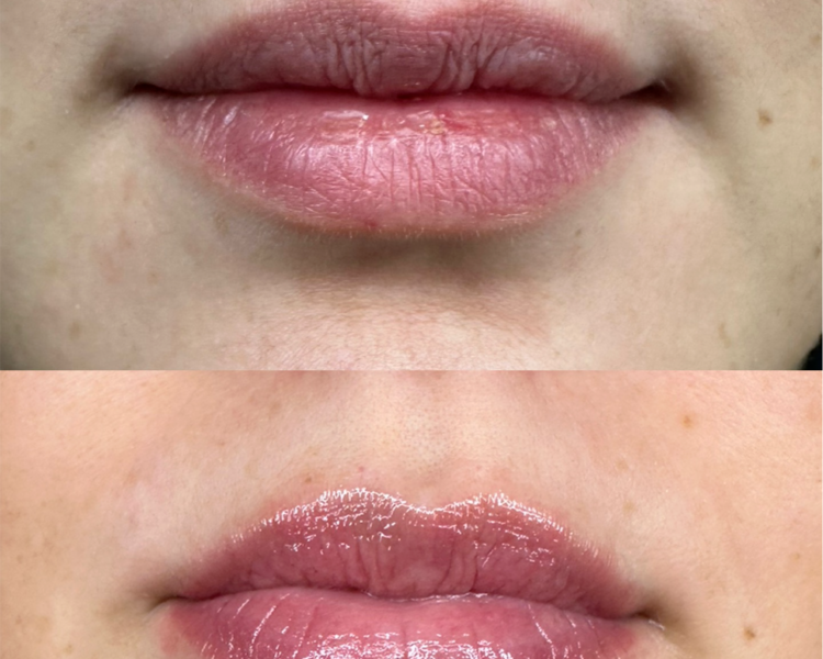 Hydralips hidratación de labios