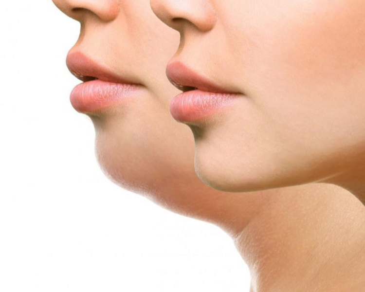 ✨ Lipopapada sin cirugía ✨